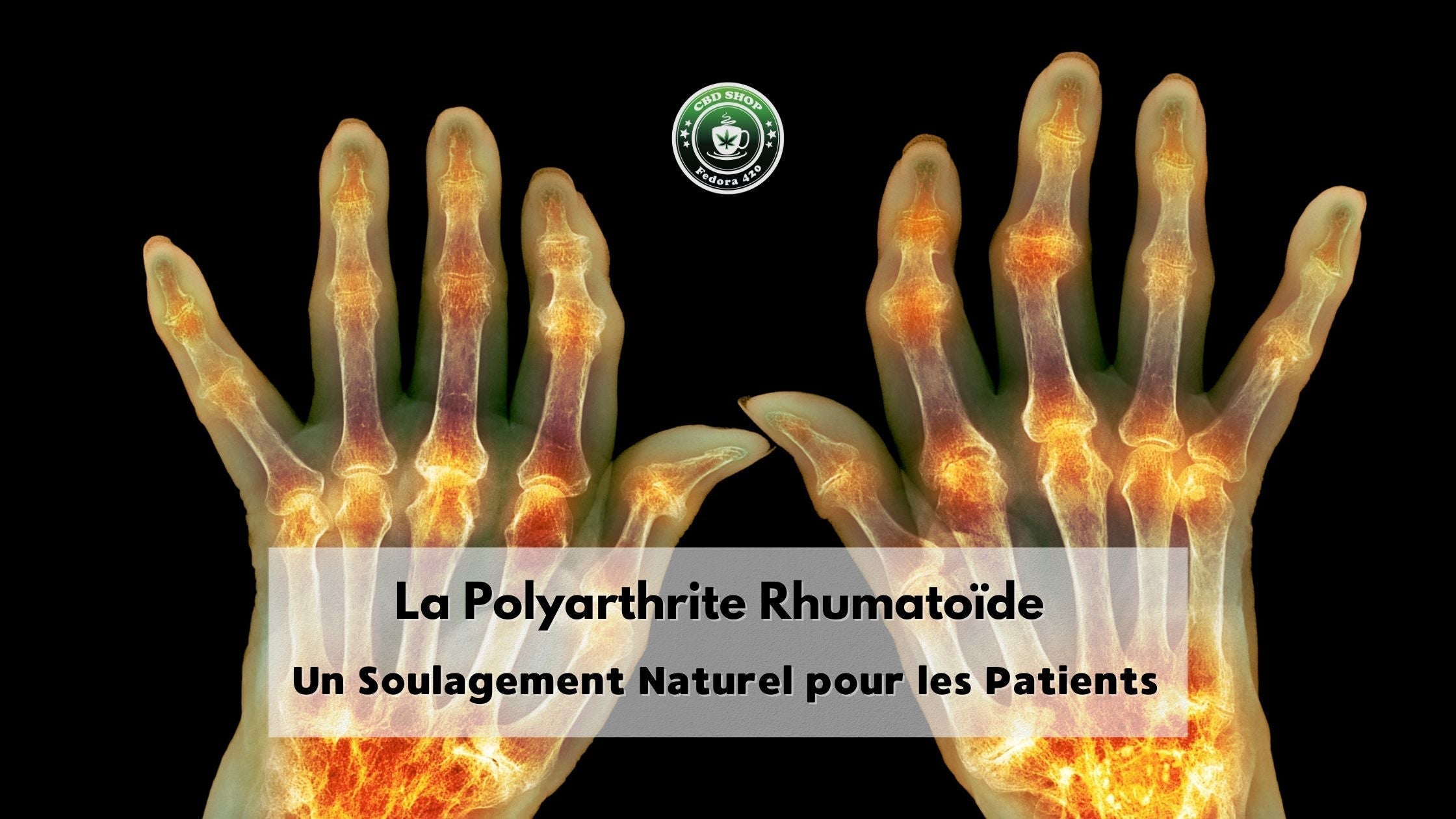 CBD et polyarthrite rhumatoïde : soulagement des douleurs articulaires