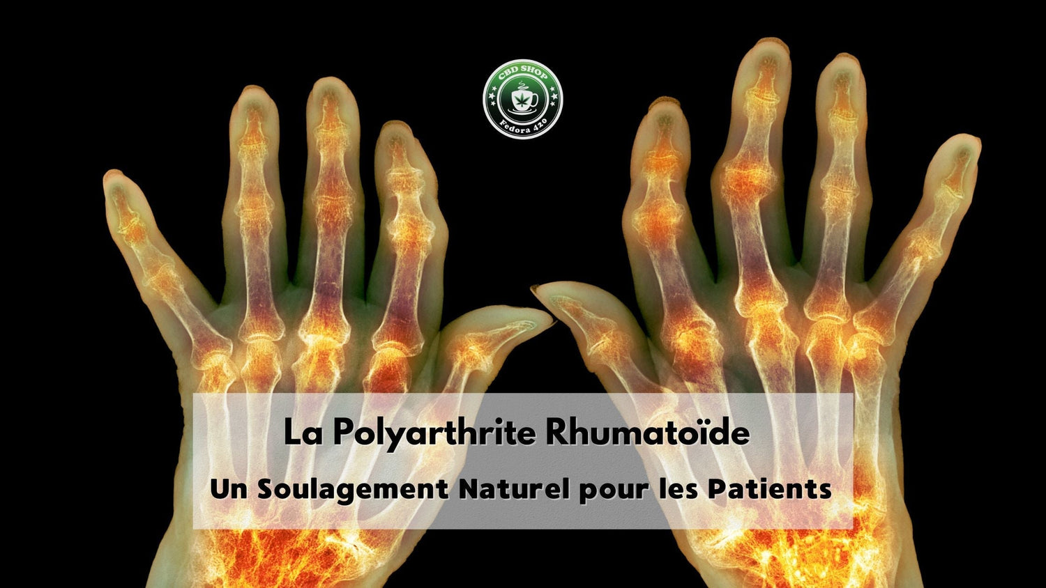 CBD et polyarthrite rhumatoïde : soulagement des douleurs articulaires